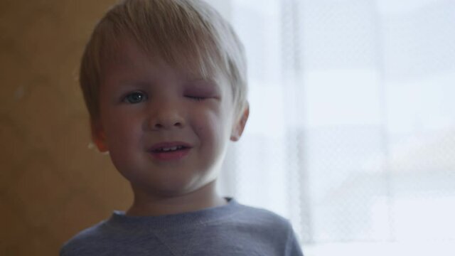 portrait of male child with edema and bruise in eye received from a blow or fall during dangerous games, parenting