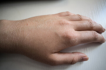 Severely dry hand skin close up