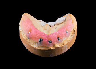 ceramic crowns done on 8 implants