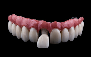 ceramic crowns done on 8 implants