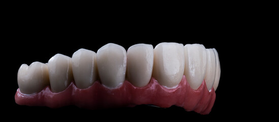 ceramic crowns done on 8 implants