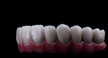 ceramic crowns done on 8 implants