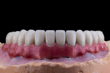 ceramic crowns done on 8 implants