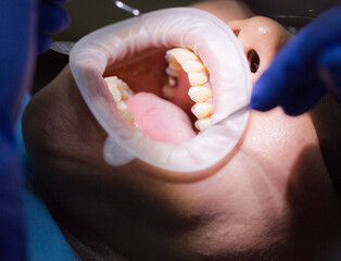 Asian female patient on dentist appointment during dental procedure. Human mouth open close up....