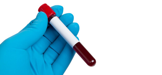 Coronavirus 2019-nCoV Blood Sample.