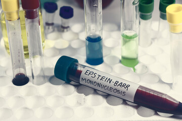 Mononucleosis and Epstein-barr virus blood test sample in lab