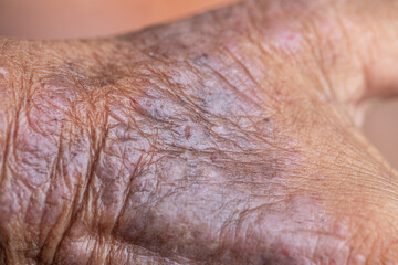 Fototapeta premium A physical of Atopic dermatitis (AD), also known as atopic eczema, is a type of inflammation of the skin (dermatitis). 