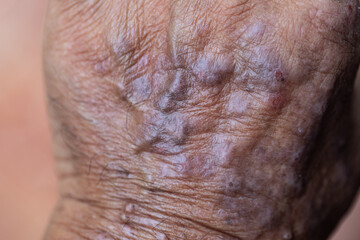 Fototapeta premium A physical of Atopic dermatitis (AD), also known as atopic eczema, is a type of inflammation of the skin (dermatitis). 