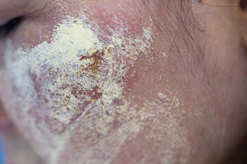 Fototapeta premium Backgrounds of lesions skin caused by acne on the face in the clinic. 