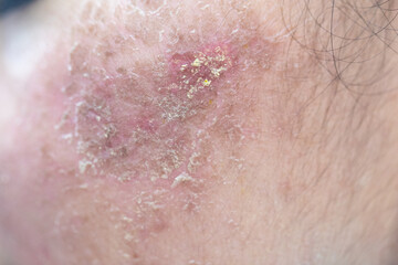 Backgrounds of lesions skin caused by acne on the face in the clinic.
