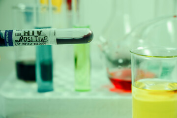 HIV blood test tube sample, aids and immune viruses.