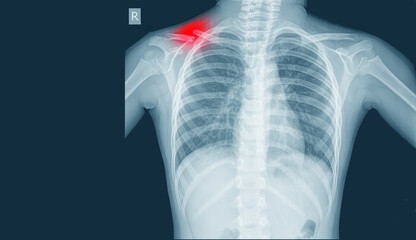 X-Ray Image Of Chest for a medical diagnosis views Showing fracture middle cavicle on red...