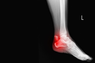 Film ankle X-ray radiograph showing heel bone broken (close fracture calcaneus) . Medical...