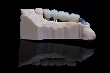 temporary dental bridge on a polymer model, the model was made on a 3D printer, filmed on a black background