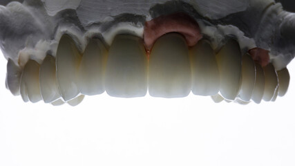 a beautiful set of upper jaw veneers on a white background with a gap on the incisal edge of the central incisors © Dental Pro Content