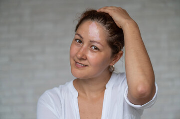 Smiling girl with an autoimmune disease affecting the skin. Portrait of a woman with a pigmented...