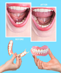 Dental rehabilitation with upper and lower prosthesis, before and after treatment