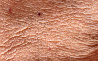 Wrinkled skin and birthmark of elderly women.
