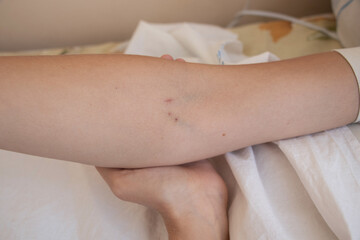 wounds from a needle on the veins of a young girl's hand were sent to hospitals © Виктория Котлярчук