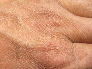 Dry skin due to excessive use of hand sanitizer 