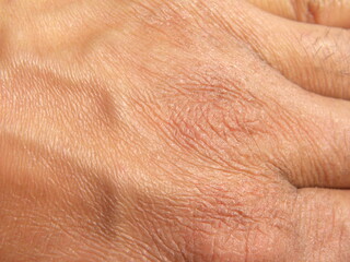 Fototapeta premium Dry skin due to excessive use of hand sanitizer 