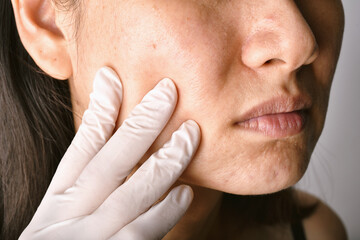 Doctor or Dermatologist hand exam patient face. Skin problems and acne scar, Acne facial care...