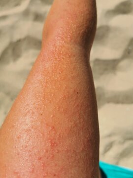 Frau mit Sonnenallergie auf dem Arm, ohne Sonnenschutz haut verbrannt