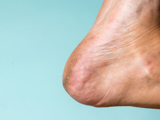 Skin diseases on the heel of a man on a blue background.