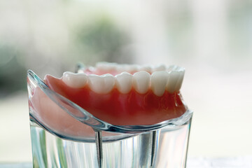 Teeth model showing an implant crown bridge model/ dental demonstration teeth study teach model.