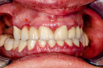 close up of teeth with periodontosis