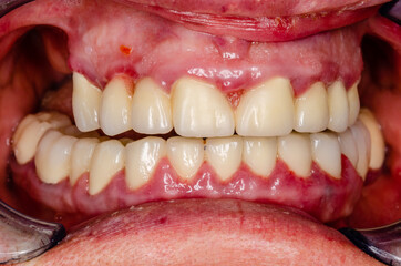 close up of teeth with inflammation