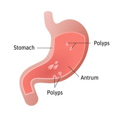 gastric polyps, masses of cells that form on the lining inside stomach. pedunculated and flat-based polyp. Antrum. Medical vector illustration marked with lines