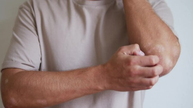 Close up of male scratching elbow as it is affected by psoriasis autoimmune skin condition