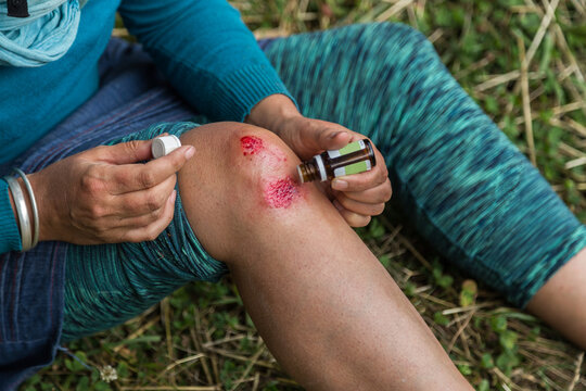 Aromatherapy first aid after bicycle crash