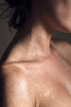 Skin with tinea versicolor