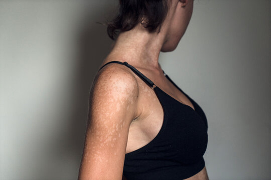 Skin with tinea versicolor