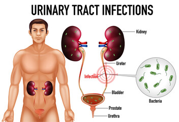 Obraz premium Informative illustration of urinary tract infections