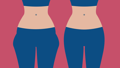 Hip liposuction, hip correction before and after