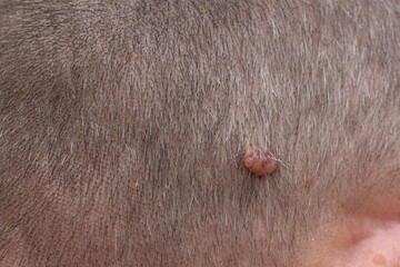 A neoplasm on the scalp of a man. (Papilloma, condyloma, melanoma, wart).  Selective focus,  Healthcare concept.