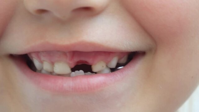 A little girl smiles without one upper tooth. The milk tooth fell out. Baby milk swell