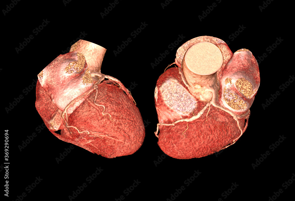 Poster lateral ad top view of cta coronary artery 3d rendering image isolated o black backgroud for finding