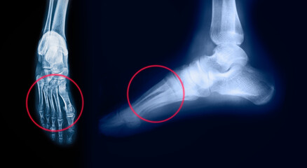 Foot pain on x-ray  isolated on black background