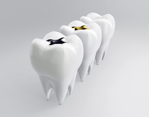 Teeth with gold, amalgam and composite inlay dental filling. Molars on white backdrop. Different types of fillings, 3d render