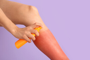 Woman with red sunburned skin applying cream against color background