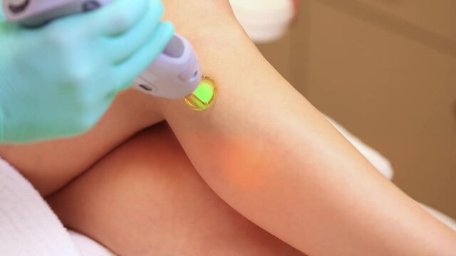 Laser hair removal with a modern device on the arm and leg of a young and beautiful woman. Hair removal by laser surgery