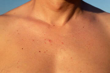 red acne a rash in the chest area of a guy. closeup. Unhealthy skin, dermatosis, purulent dermatitis carbuncle, furuncle, diseases of the skin and hair follicles purulent foliculitis