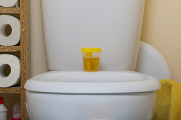 Urine in a container for analysis. Stands on the toilet seat. Disposable medical polymeric sterile container with a built-in holder for a vacuum test tube with a screw cap.