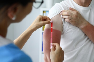 Healthcare professional determines degree of sunburn in patient First aid concept