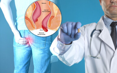 Doctor holding suppository near man suffering from hemorrhoid pain. Illustration of unhealthy lower...