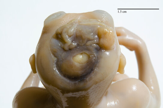 17 week old male human fetus with anencephaly, head, upper view.